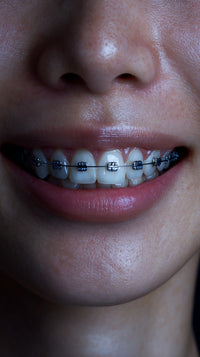 A Close Up Of A Smiling Woman Wearing Braces — Stock Photo
