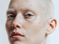 A Close Up Portrait Of An Individual With Albinism Emphasizing Their Distinctive Features And Promoting Awareness For The Condition — Stock Photo
