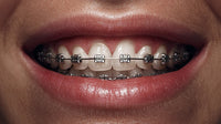 A Close Up Image Of A Person S Smiling Mouth Showcasing Braces — Stock Photo