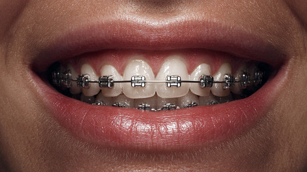 A Close Up Image Of A Person S Smiling Mouth Showcasing Braces — Stock Photo