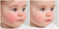 Three Images Of A Baby With Red Rashes On Their Face Captured From Different Angles And Perspectives — Stock Photo
