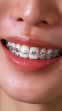 A Woman Smiling Broadly Revealing A Set Of Braces — Stock Photo